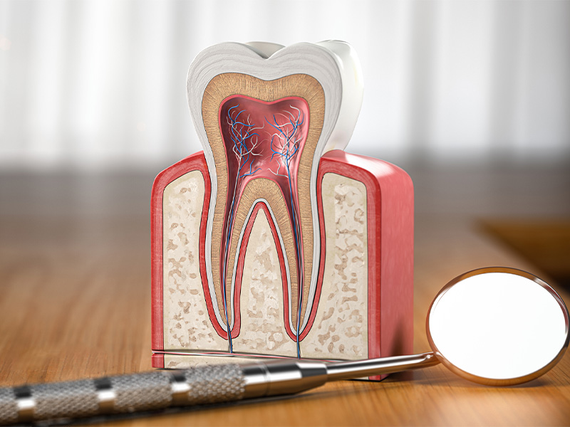 根管治療