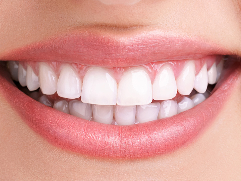 ホワイトニング