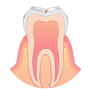 CO（ごく初期のむし歯）