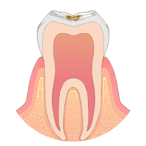 C1（エナメル質のむし歯）