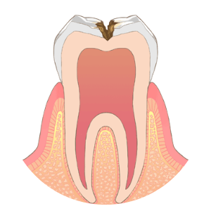C2（象牙質まで進行したむし歯）