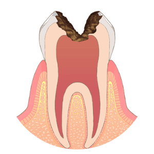 C3（神経に達したむし歯）