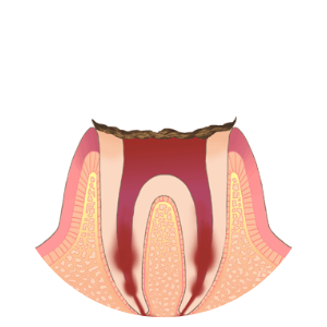 C4（歯根まで進行したむし歯）