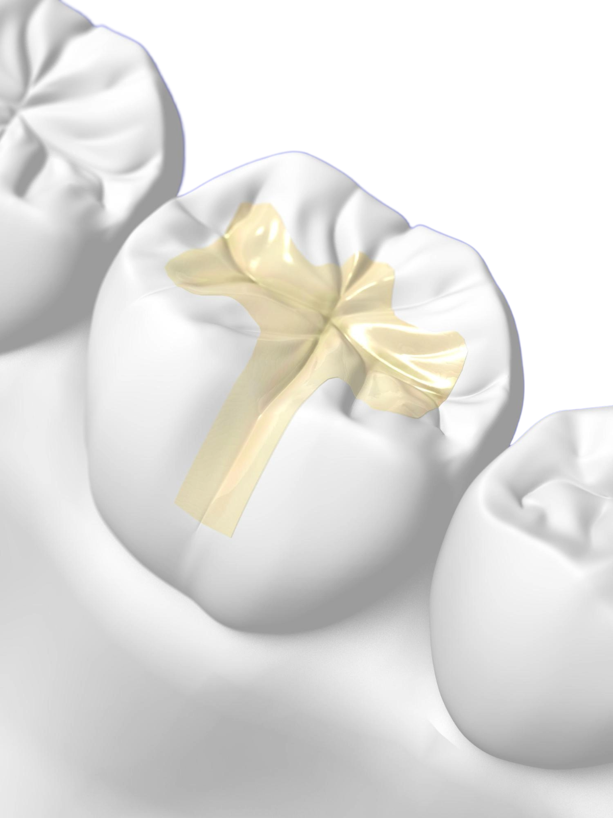 身体にやさしい、金属を使わないメタルフリー治療