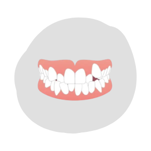 歯並びがガタガタ・凸凹（叢生）