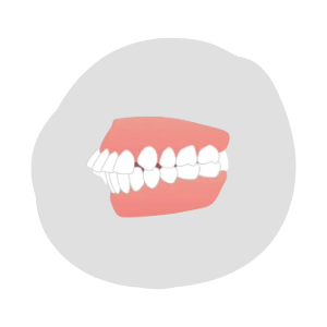 出っ歯（上顎前突）