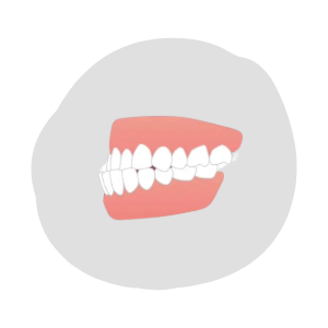 受け口（下顎前突）