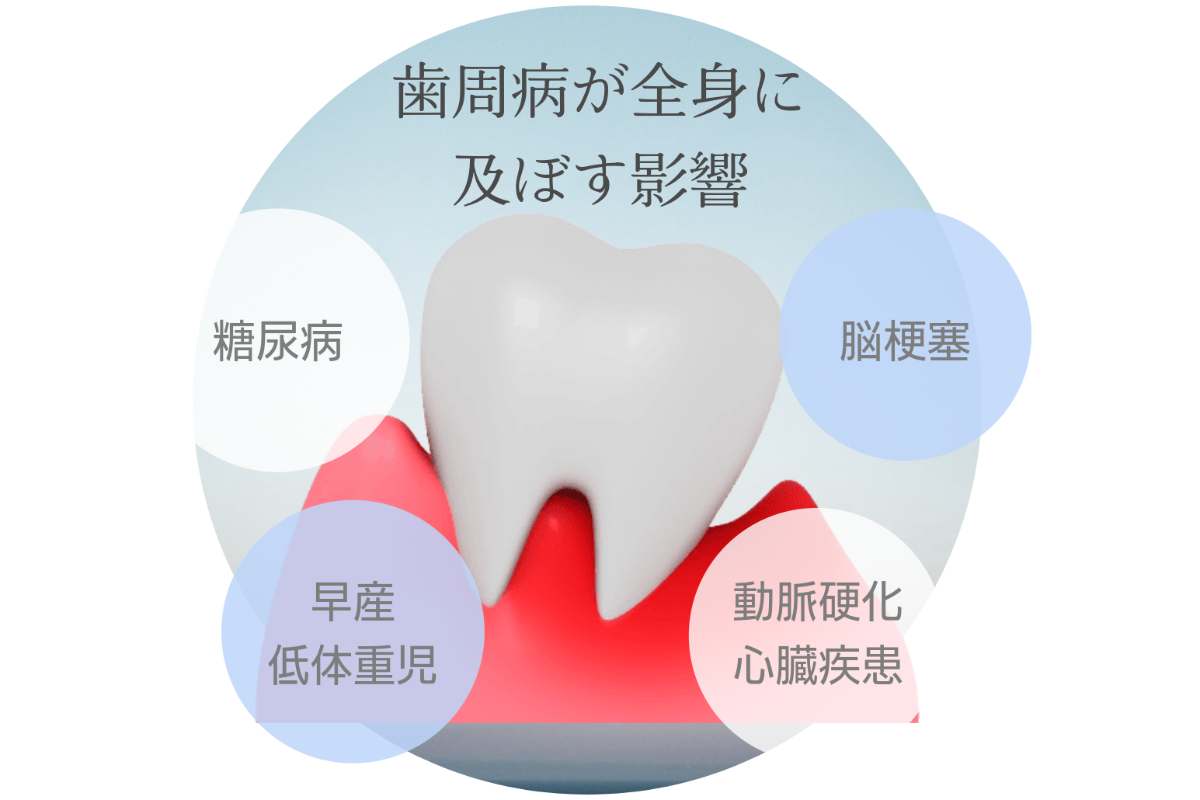 歯周病が引き起こす全身疾患のリスク