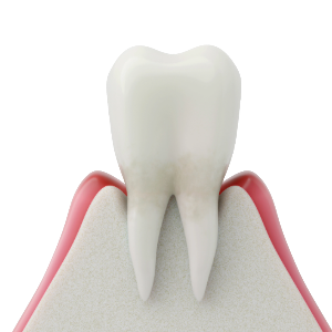 軽度歯周炎【歯を支える組織に影響が出始める段階】