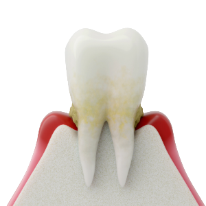 中等度歯周炎【歯の支えが弱くなり症状が出始める段階】