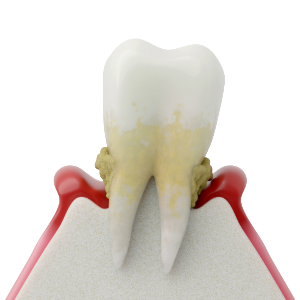 重度歯周炎【歯を残せるかどうかの判断が必要な段階】